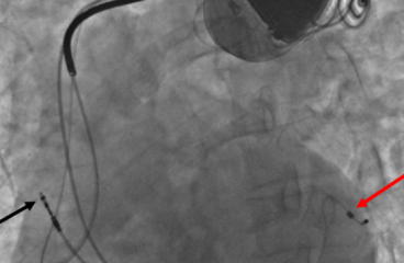 CRTD therapy for heart failure is best done at Agra Heart Centre by Dr Rajat Rawat and Dr CR Rawat. This is the only and best hospital offering CRTD therapy in Agra