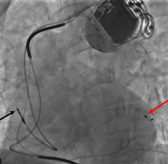 CRTD Device Therapy for Advanced Heart Failure in Agra CRTD Device Therapy for Advanced Heart Failure in Agra